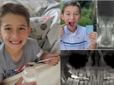 wishdom teeth